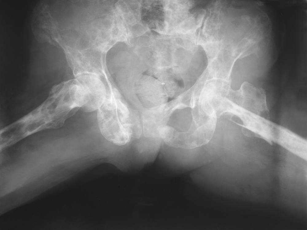 x-ray of patient with multiple myeloma showing multiple punch out bone lesions