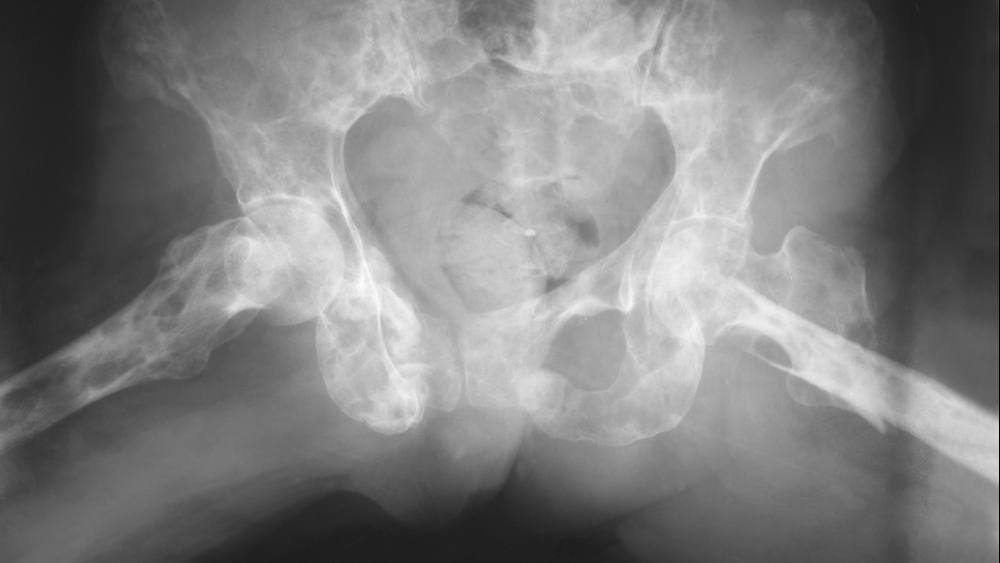 Radiografía de un paciente con mieloma múltiple que muestra varias lesiones óseas