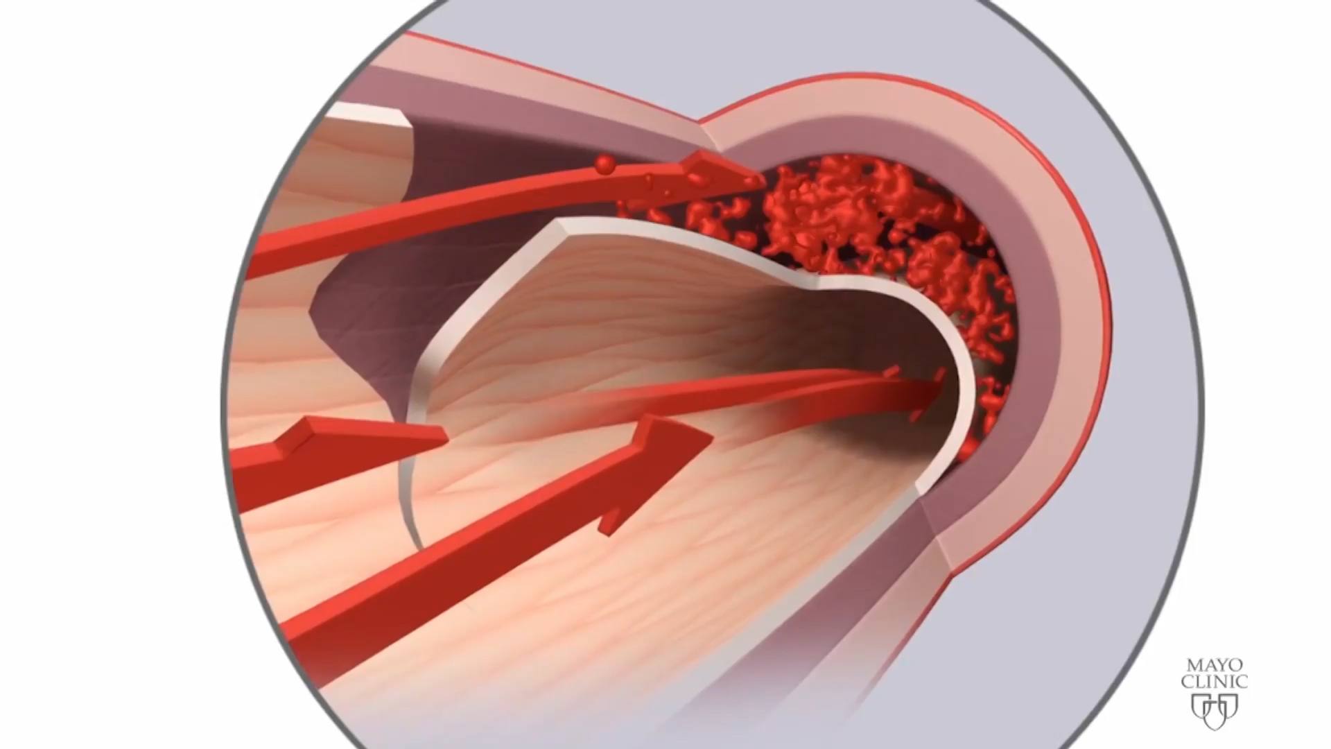 What Is Postpartum Coronary Artery Dissection