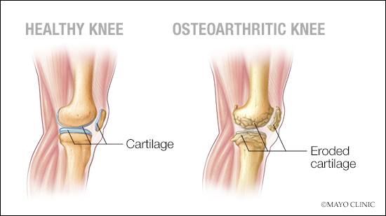Ilustración médica de una articulación sana de la rodilla y de otra con osteoartritis