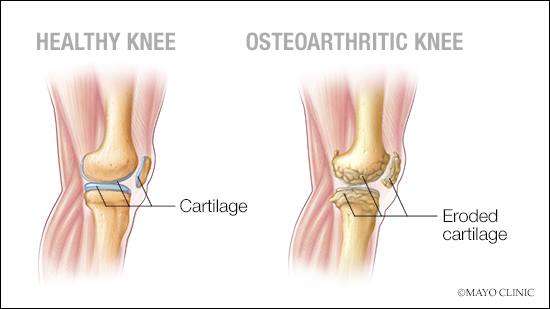 Arthritis - Symptoms and causes - Mayo Clinic