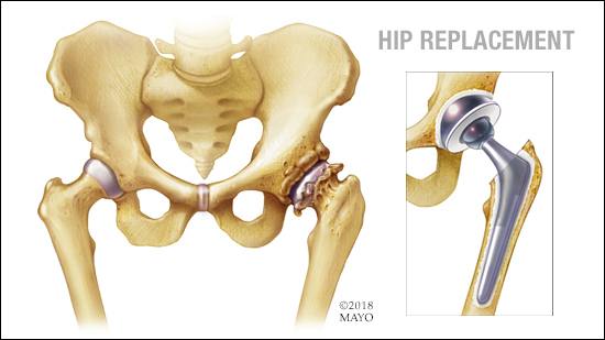 a medical illustration of hip replacement