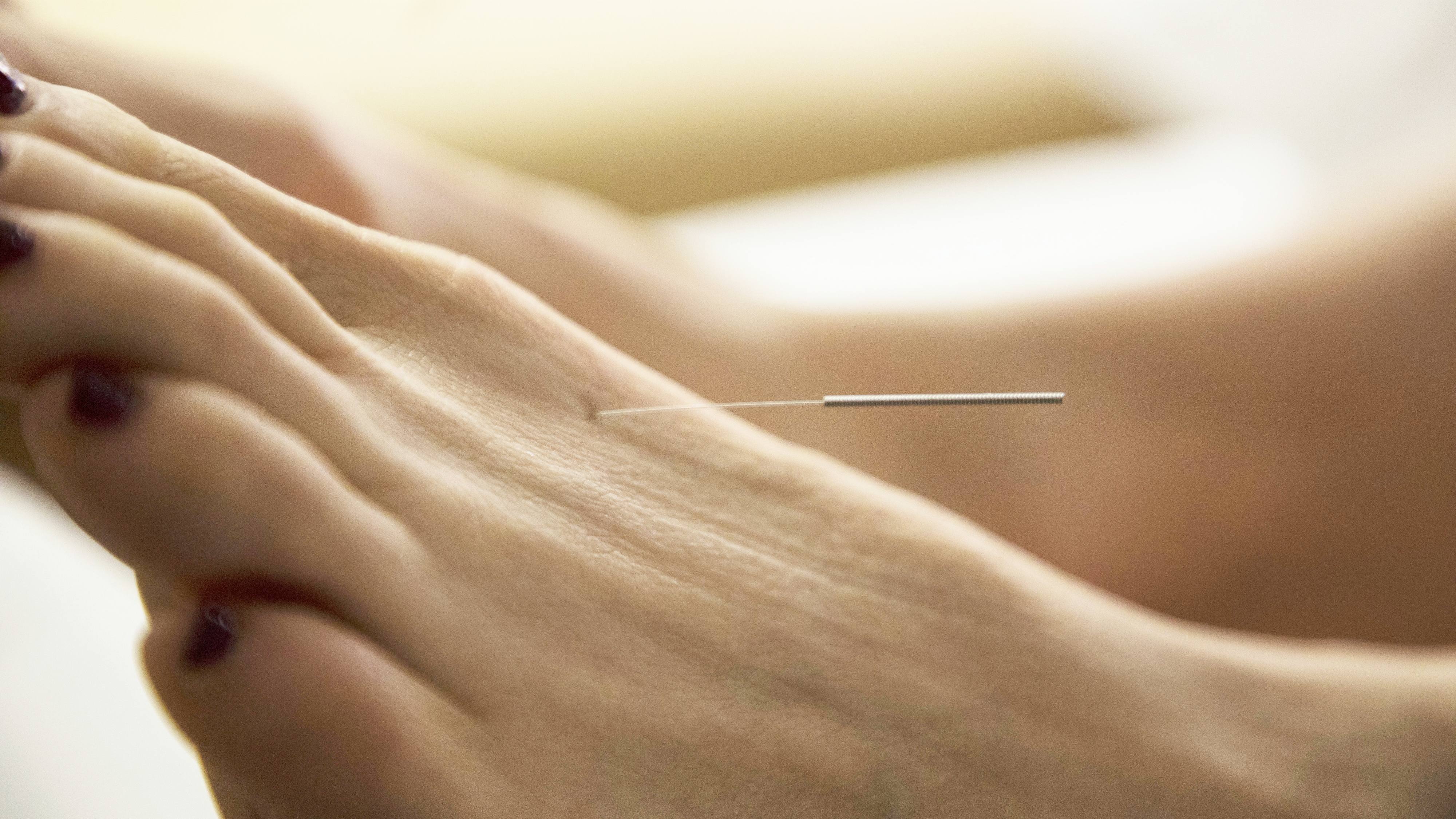 a women's foot with a needle in it during an acupuncture therapy session