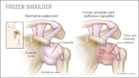 Ilustración médica de una articulación normal  del hombro y otra de un hombro congelado (capsulitis adhesiva)