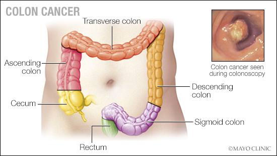 a medical illustration of the rectum, sigmoid colon, descending colon, transverse colon, ascending colon and secum, as well as an image of colon cancer seen during colonoscopy, colorectal
