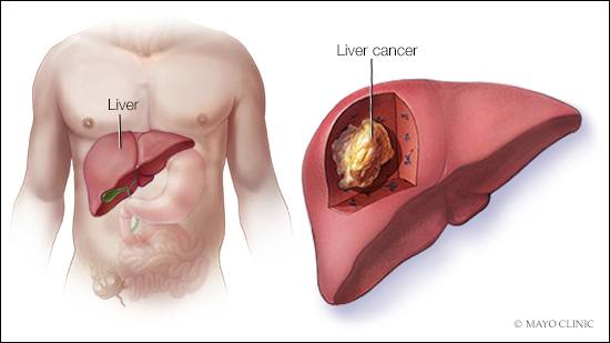 a medical illustration of liver cancer