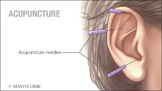 Ilustración médica de la acupuntura que muestra tres agujas colocadas en la parte externa del oído