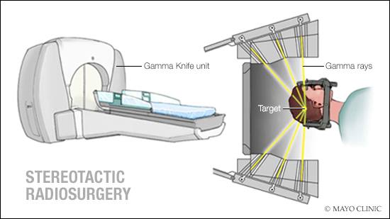 a medical illustration of stereotactic radiosurgery