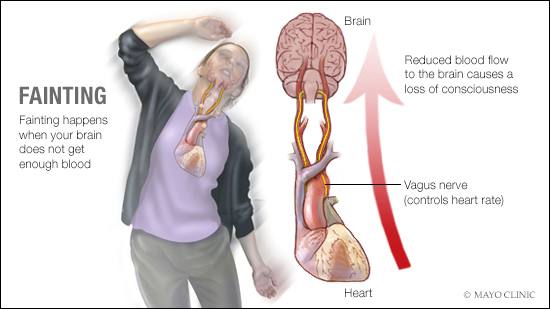 a medical illustration of the cause of fainting