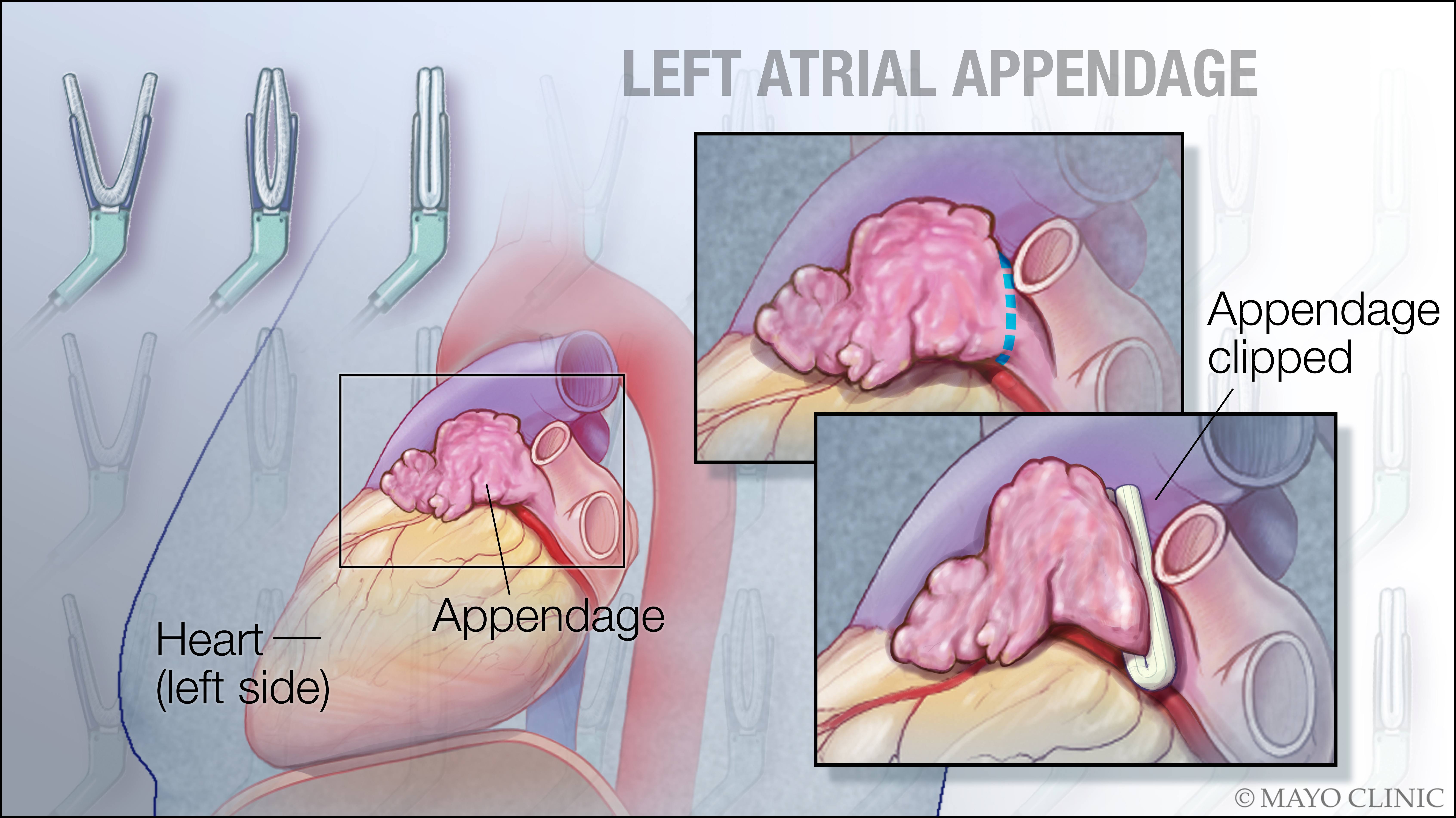 illustration of left atrial appendage