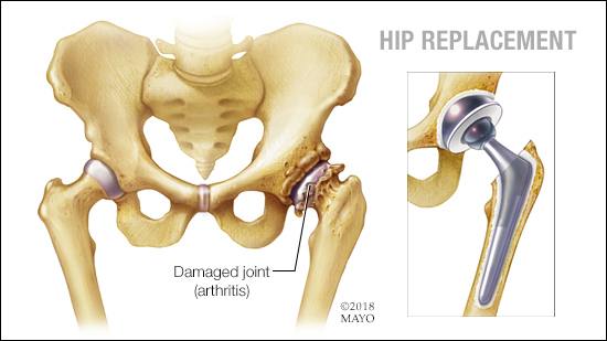 a medical illustration of a hip joint replacement for a hip joint damaged by arthritis