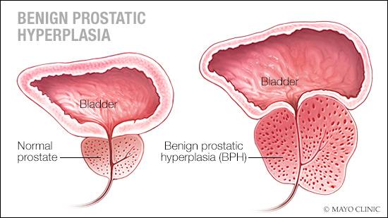 Ilustración médica de una próstata normal y de otra con hipertrofia prostática benigna