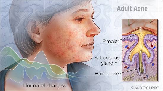 Ilustración médica del acné en adultos