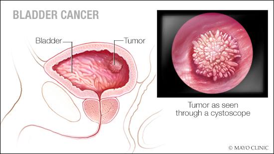 Ilustración médica del cáncer de la vejiga