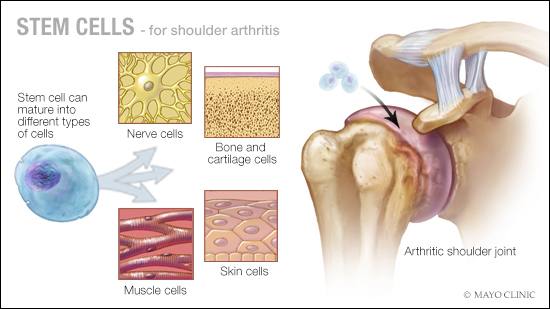 a medical illustration of stem cell therapy for shoulder joint arthritis