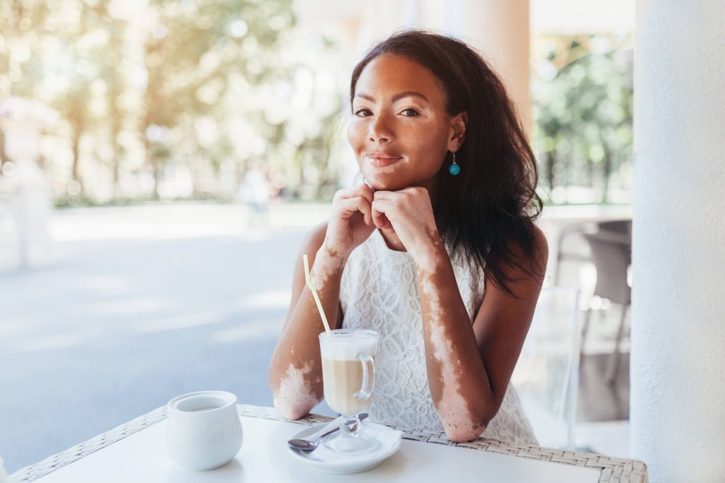 a young woman with vitiligo affecting her face and arms, sitting in an outdoor cafe drinking iced coffee