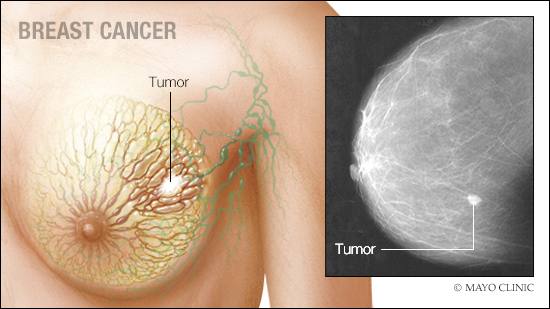 a medical illustration of breast cancer