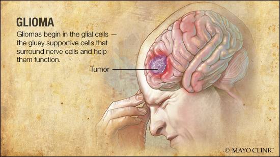 a medical illustration of glioma