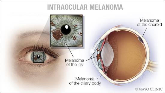 a medical illustration of intraocular melanoma