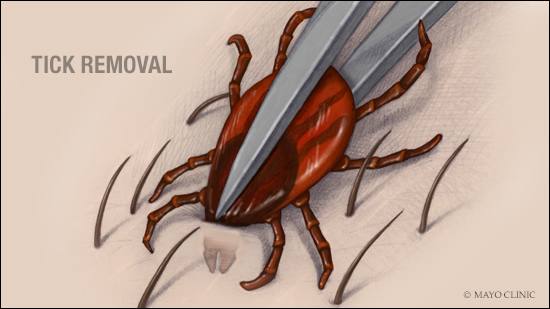 a medical illustration of the proper way to remove a tick that's embedded in the skin