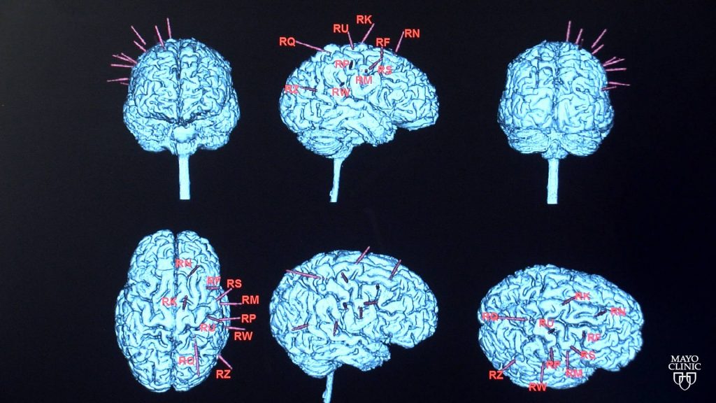 epilepsy brain scans 