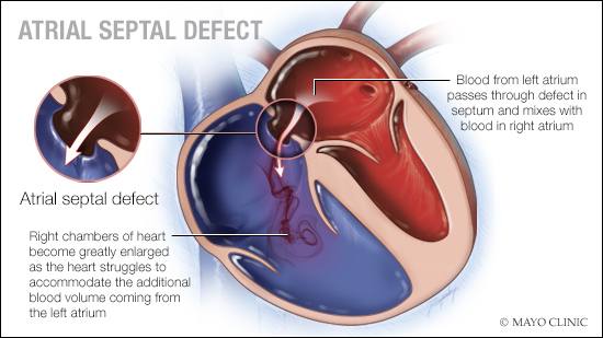 a medical illustration of atrial septal defect