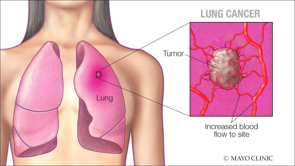 a medical illustration of lung cancer