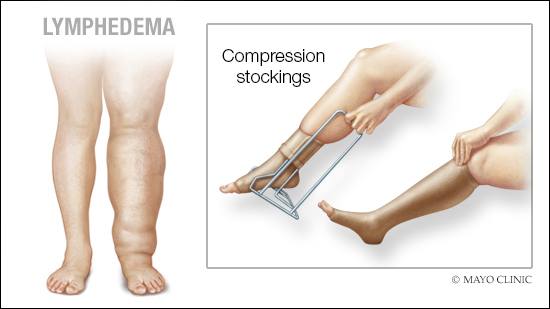 Lymphedema: Why and how compression therapy helps