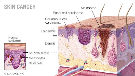 a medical illustration of normal skin and three types of skin cancer - squamous cell carcinoma, basal cell carcinoma and melanoma