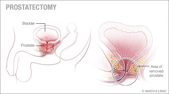 a medical illustration of prostatectomy