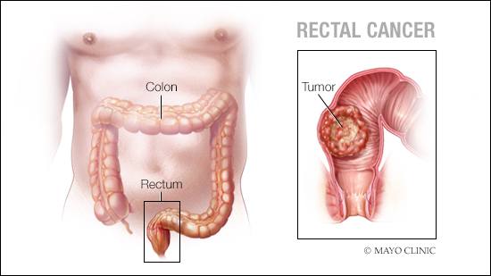 a medical illustration of rectal cancer