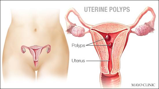 a medical illustration of uterine polyps