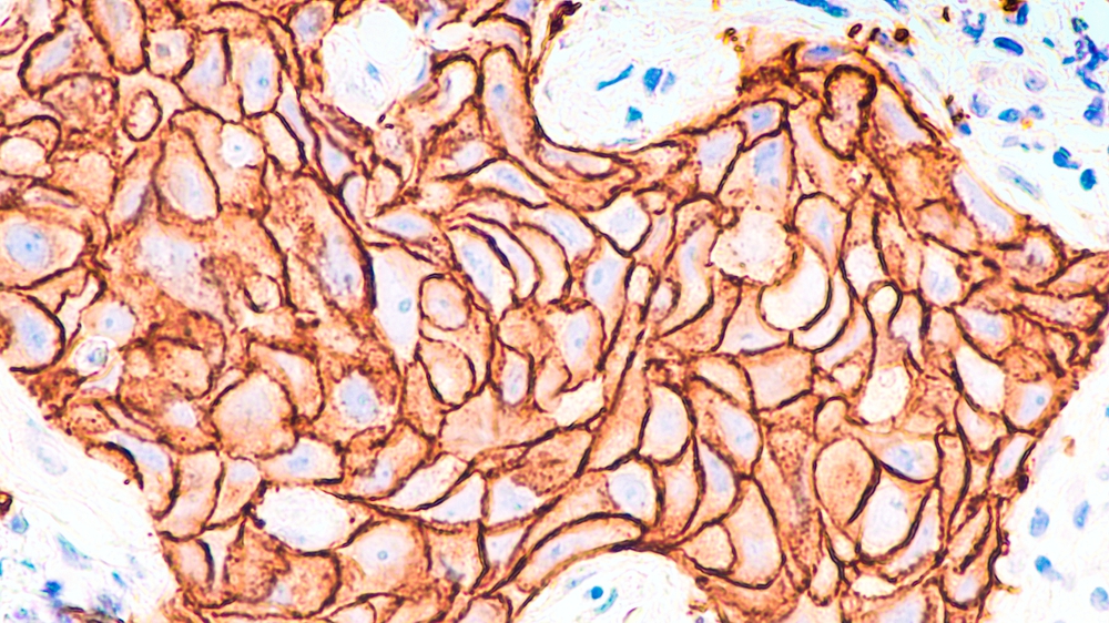 El análisis inmunohistoquímico para HER2 del estudio de patología de este carcinoma ductal infiltrante y mal diferenciado muestra tinción positiva en la membrana celular