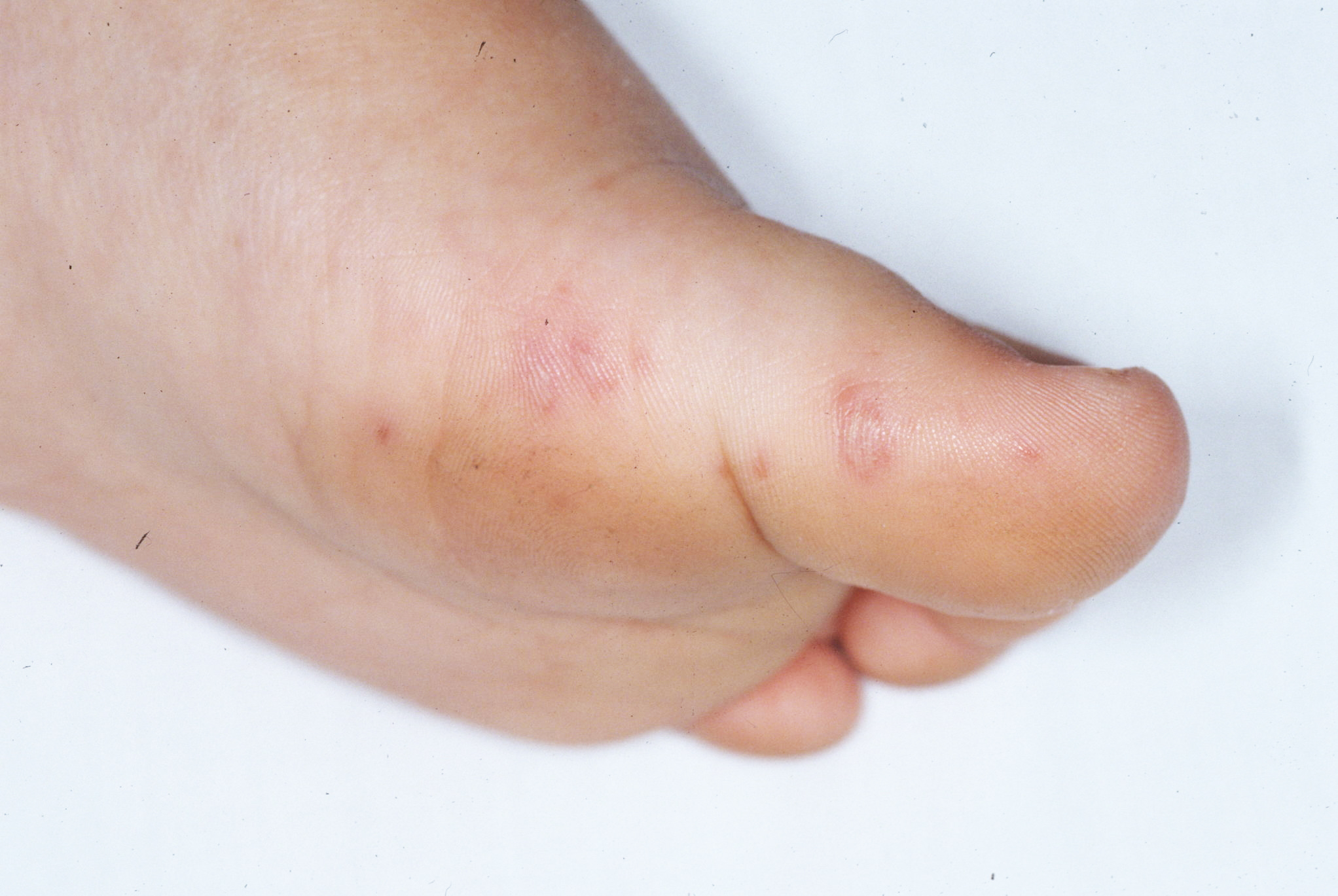 a child's foot with red sores being examined for hand, foot and mouth disease