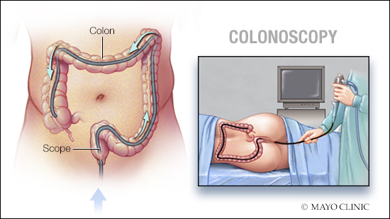 Ilustración médica de la colonoscopia