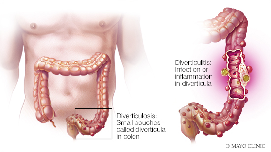 Ilustración médica de la diverticulosis y la diverticulitis