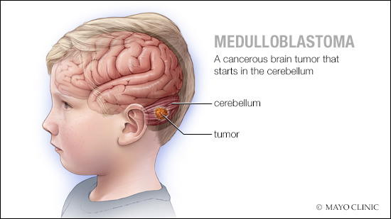 a medical illustration of medulloblastoma