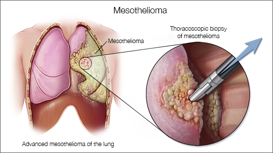 a medical illustration of mesothelioma