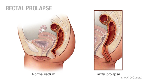 Ilustración médica del prolapso rectal