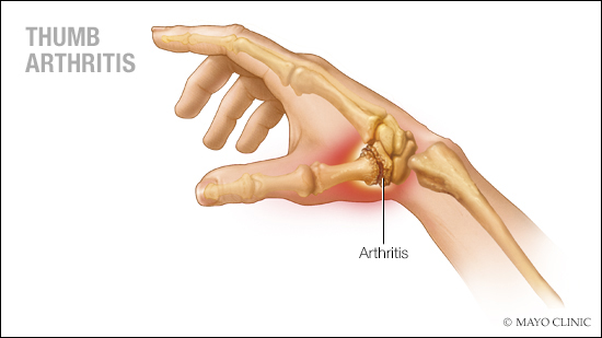 Ilustración médica de la artritis del pulgar