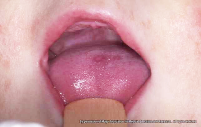 a child's mouth with red sores, open wide being examined for hand, foot and mouth disease