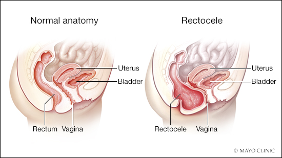 a medical illustration of normal rectum and vagina anatomy and a posterior vaginal prolapse 