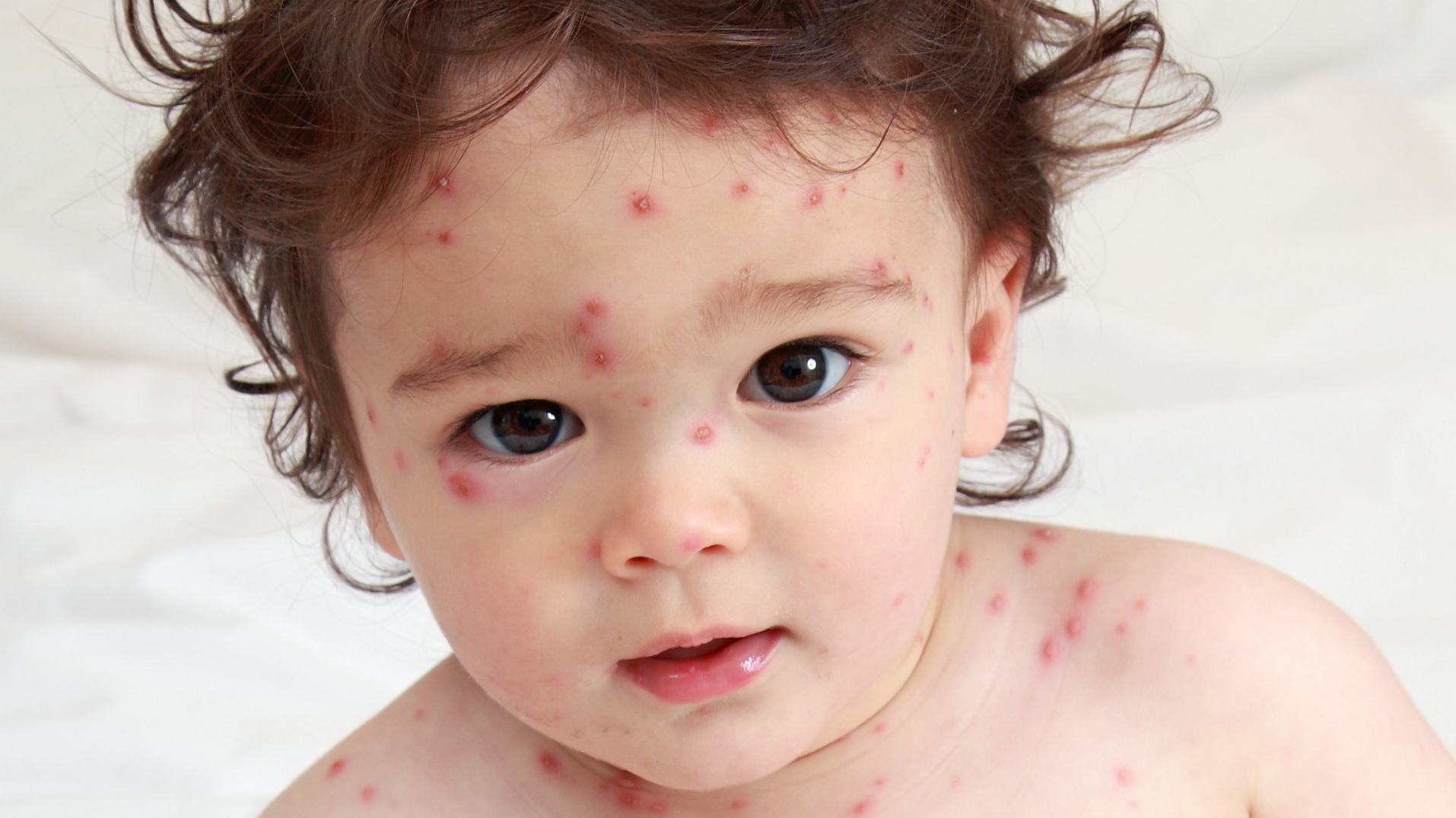 a young child, toddler, with a chicken pox rash on face and torso