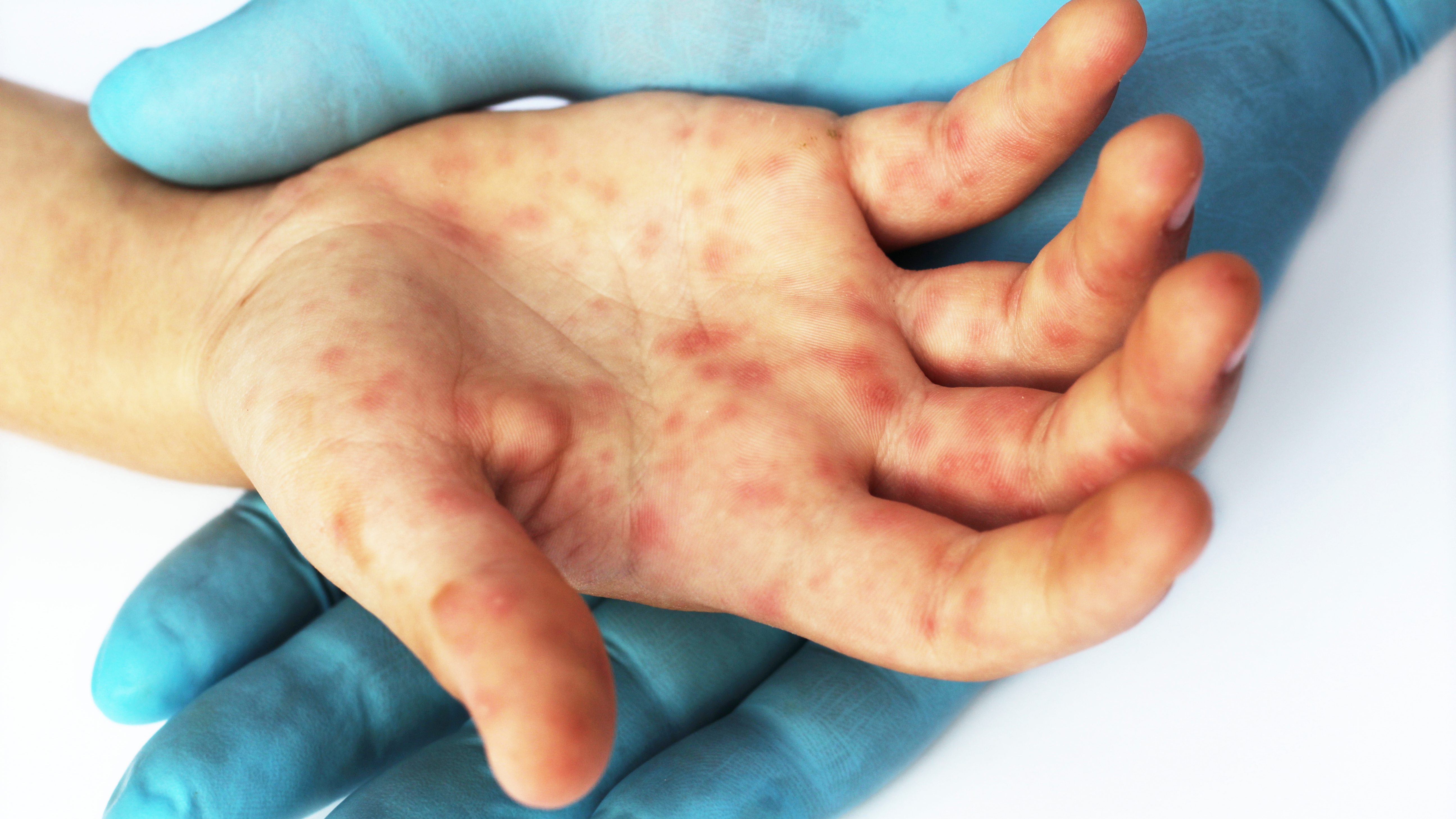 red spots and rash on infected hand with viral disease, perhaps hand foot and mouth disease, an enterovirus