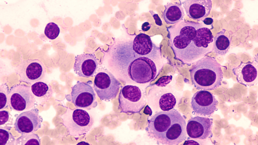 Fine needle aspirate cytology of metastatic melanoma, with large malignant cells.