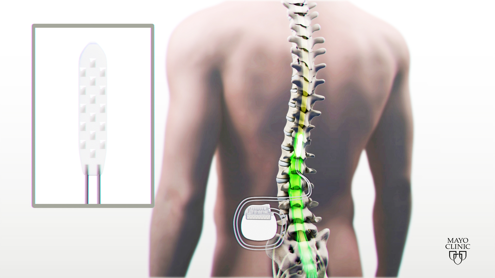 medical illustration of spinal stimulation device