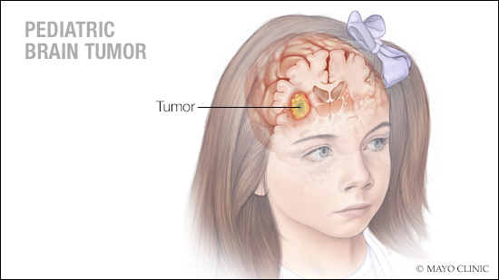 a medical illustration of a pediatric brain tumor - in a young girl