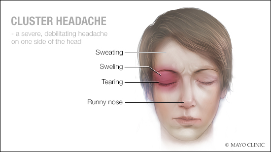 a medical illustration of cluster headache