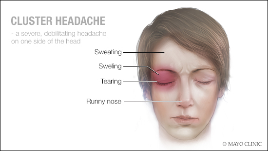 Is Working From Home Giving You a Headache or Migraine Attack?