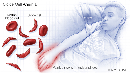 sickle cell anemia symptoms in adults